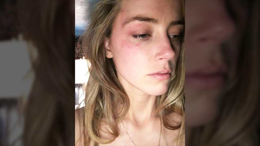 Amber Heard, Johnny Depp tarafından şiddet gördüğünü iddia etti