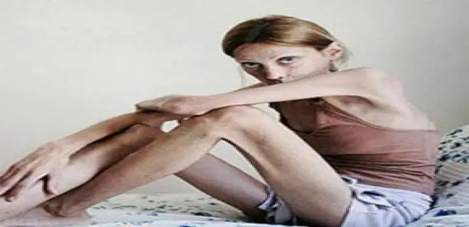anoreksiya nedir ve nasil tedavi edilir 6238ed41b2ee9