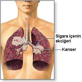 Akciğer apsesi Nedir ? Nedenleri ve Tedavisi