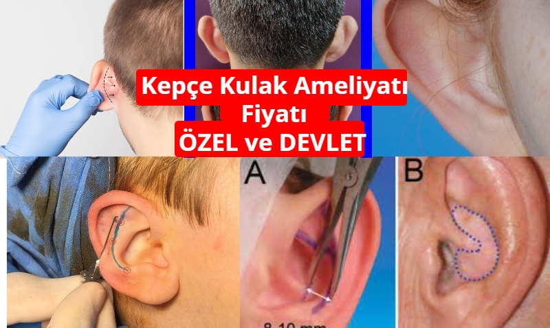 Kepçe Kulak Ameliyatı Fiyatları SGK [Özel ve Devlet] 2022