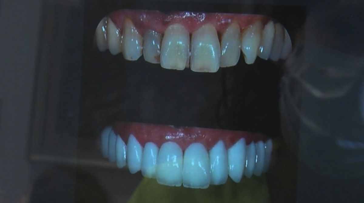 Porselen diş çılgınlığı: Sanıldığı kadar masum değil #5