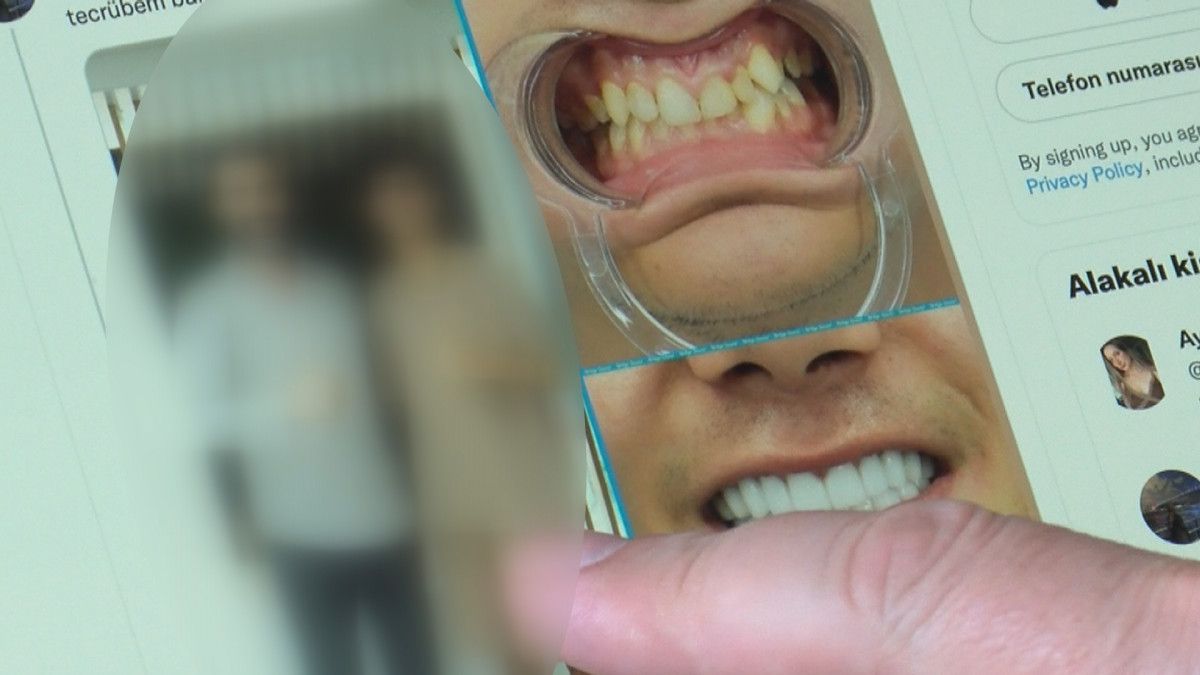Porselen diş çılgınlığı: Sanıldığı kadar masum değil #3