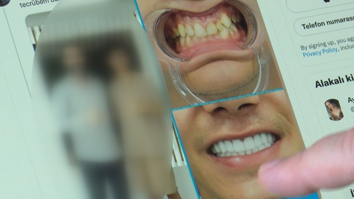 Porselen diş çılgınlığı: Sanıldığı kadar masum değil #4