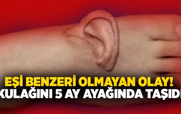 Eşi benzeri olmayan olay.. Kulağını 5 ay ayağında taşıdı!